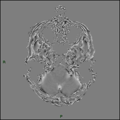 Cerebral amyloid angiopathy (Radiopaedia 77506-89664 H 18).jpg