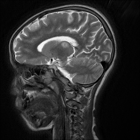 File:Cerebral and spinal tuberculosis (Radiopaedia 90489-107837 Sagittal T2 9).jpg
