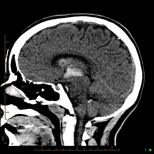 Cerebral arteriovenous malformation (AVM) (Radiopaedia 78162-90706 A 42).jpg