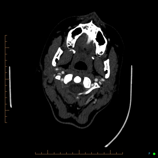 Cerebral arteriovenous malformation (AVM) (Radiopaedia 78162-90706 Axial CTA 24).jpg