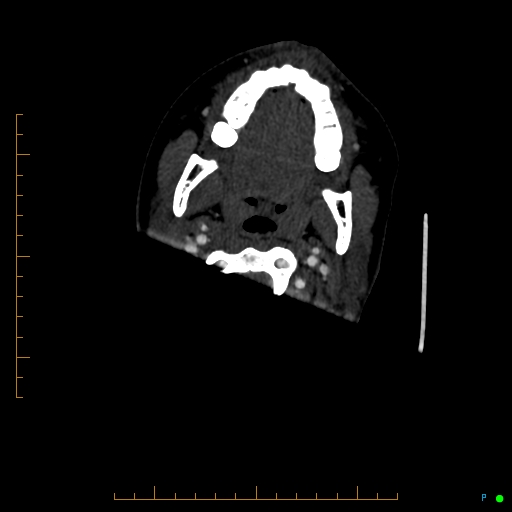Cerebral arteriovenous malformation (AVM) (Radiopaedia 78162-90706 Axial CTA 9).jpg