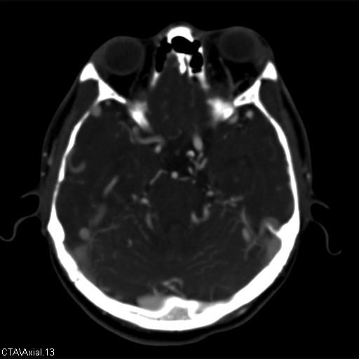 Cerebral arteriovenous malformation (Radiopaedia 28518-28759 B 13).jpg