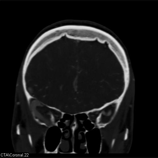 Cerebral arteriovenous malformation (Radiopaedia 28518-28759 C 22).jpg