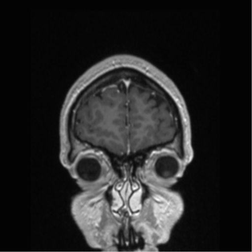 Cerebral arteriovenous malformation (Radiopaedia 39259-41506 Coronal T1 C+ 85).png