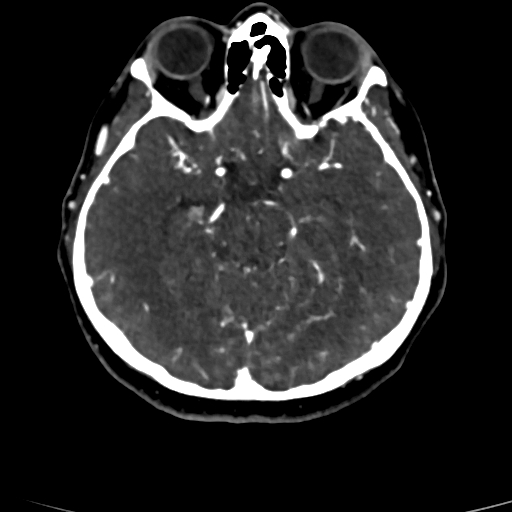 Cerebral arteriovenous malformation (Radiopaedia 73830-84645 Axial C+ delayed 57).jpg