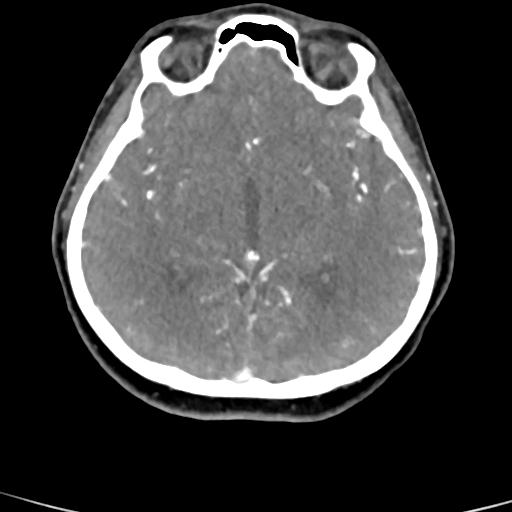 Cerebral arteriovenous malformation (Radiopaedia 73830-84645 B 54).jpg