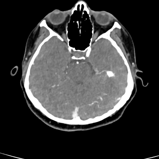 File:Cerebral arteriovenous malformation (Radiopaedia 73830-84645 B 68).jpg