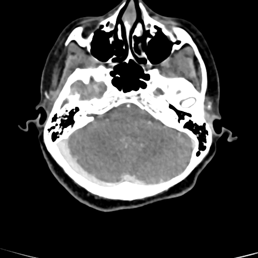 Cerebral arteriovenous malformation (Radiopaedia 73830-84645 B 76).jpg
