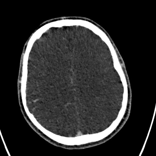 Cerebral arteriovenous malformation (Radiopaedia 78188-90746 Axial C+ delayed 118).jpg