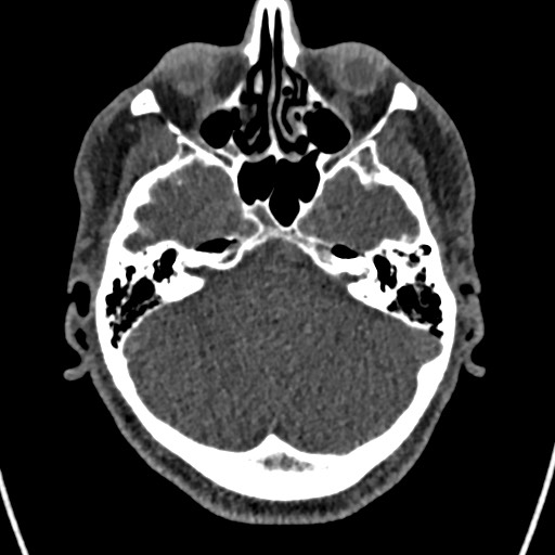 File:Cerebral arteriovenous malformation (Radiopaedia 78188-90746 Axial non-contrast 44).jpg
