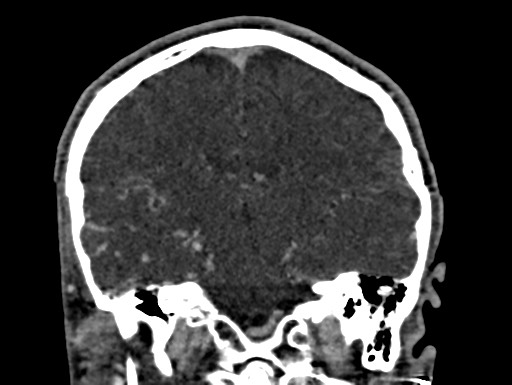 Cerebral arteriovenous malformation (Radiopaedia 78188-90746 Coronal C+ delayed 67).jpg