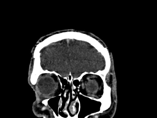 Cerebral arteriovenous malformation (Radiopaedia 78188-90746 Coronal C+ delayed 9).jpg