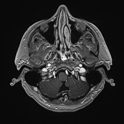 Cerebral arteriovenous malformation (Radiopaedia 84015-99245 Axial T1 C+ 30).jpg
