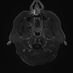 Cerebral arteriovenous malformation (Radiopaedia 84015-99245 Axial T1 C+ 5).jpg