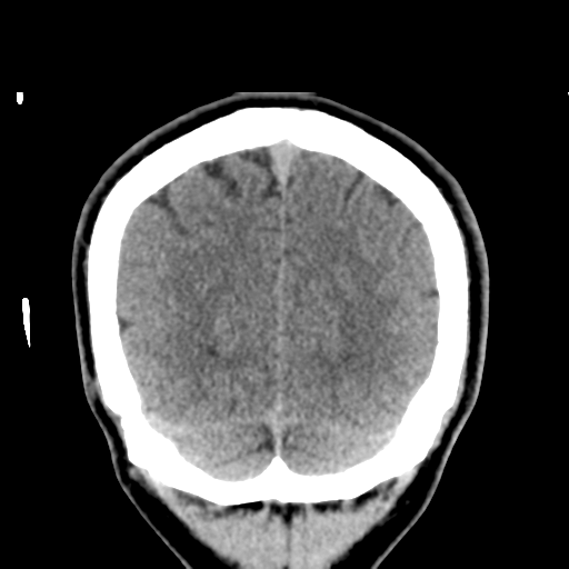 Cerebral arteriovenous malformation (Spetzler-Martin grade 2) (Radiopaedia 41262-44076 Coronal non-contrast 54).png