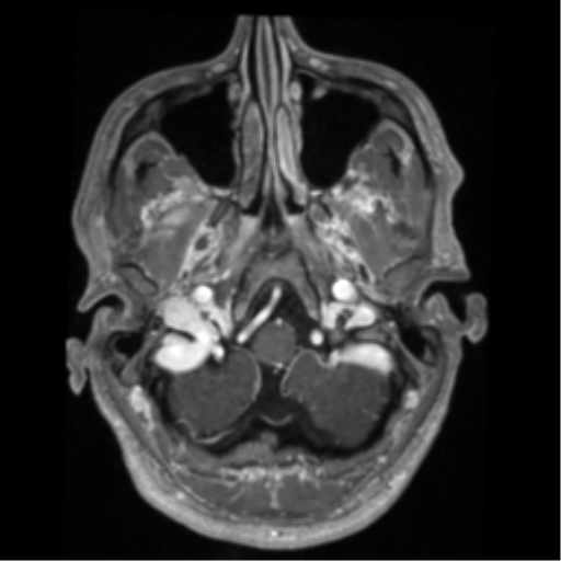 File:Cerebral arteriovenous malformation - huge (Radiopaedia 35734-37272 Axial T1 C+ 8).png