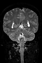 Cerebral arteriovenous malformation at posterior body of corpus callosum (Radiopaedia 74111-84925 Coronal T2 123).jpg