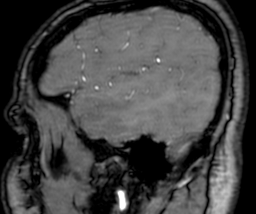 Cerebral arteriovenous malformation at posterior body of corpus callosum (Radiopaedia 74111-84925 J 42).jpg