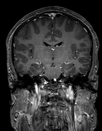 Cerebral arteriovenous malformation at posterior body of corpus callosum (Radiopaedia 74111-84925 K 190).jpg