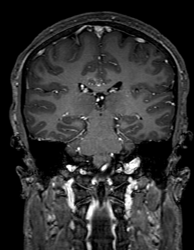 Cerebral arteriovenous malformation at posterior body of corpus callosum (Radiopaedia 74111-84925 K 217).jpg
