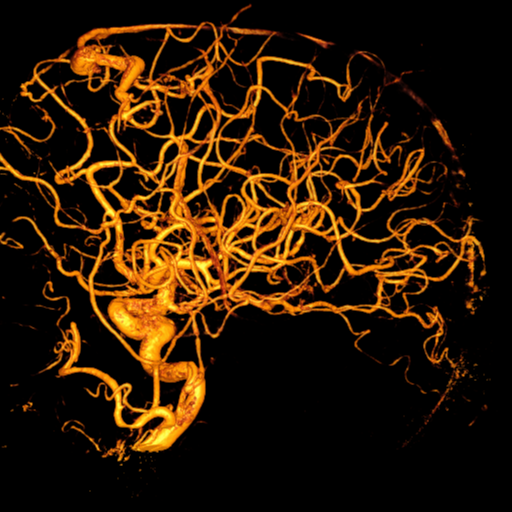 Cerebral arteriovenous malformation with lobar hemorrhage (Radiopaedia 44725-48513 Lateral 51).png