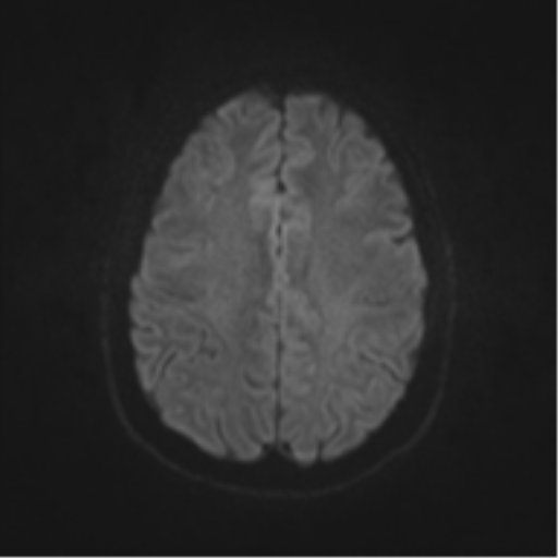 File:Cerebral cavernoma and development venous anomaly (Radiopaedia 37603-39482 Axial DWI 39).png
