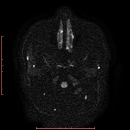 File:Cerebral cavernous malformation (Radiopaedia 26177-26306 Axial DWI 3).jpg