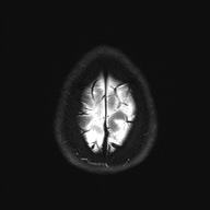 Cerebral cavernous venous malformation (Radiopaedia 70008-80021 Axial DWI 29).jpg