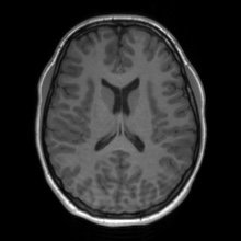 Cerebral cavernous venous malformation (Radiopaedia 70008-80021 Axial T1 45).jpg