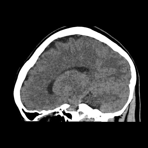 File:Cerebral cavernous venous malformation (Radiopaedia 70008-80022 C 35).jpg