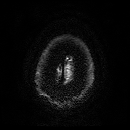 Cerebral cavernous venous malformation (Zabramski type II) (Radiopaedia 85511-101198 Axial DWI 30).jpg