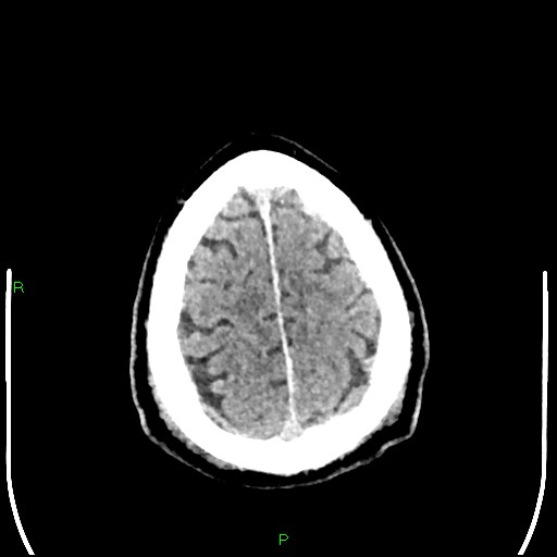Cerebral contusions (Radiopaedia 33868-35039 Axial non-contrast 191).jpg