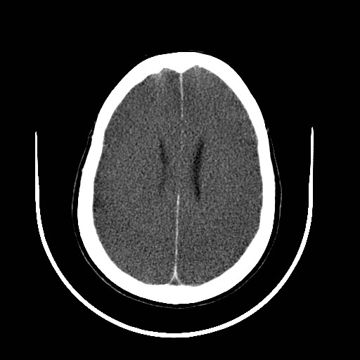 File:Cerebral edema (evolution in time) (Radiopaedia 19418-19439 non-contrast 64).jpg