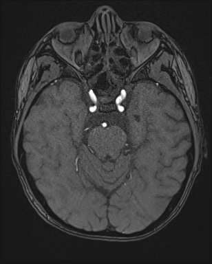 Cerebral embolic infarcts (embolic shower) (Radiopaedia 72391-82921 Axial MRA 49).jpg
