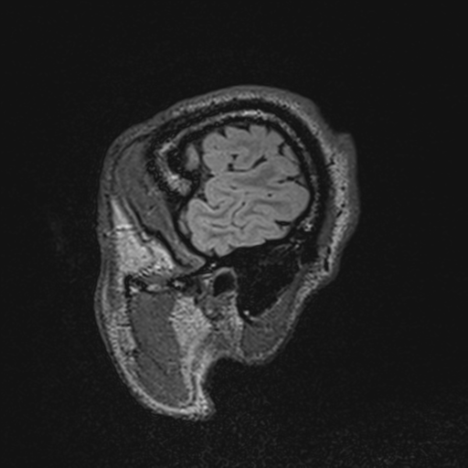 File:Cerebral hemorrhagic contusions- temporal evolution (Radiopaedia 40224-42757 Sagittal T1 10).png