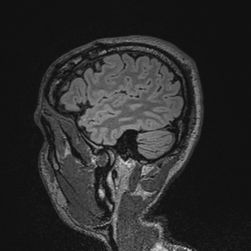 File:Cerebral hemorrhagic contusions- temporal evolution (Radiopaedia 40224-42757 Sagittal T1 16).png