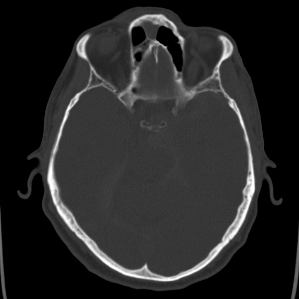 Cerebral hemorrhagic contusions (Radiopaedia 23145-23188 Axial bone window 20).jpg