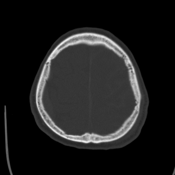 Cerebral hemorrhagic contusions (Radiopaedia 23145-23188 Axial bone window 48).jpg
