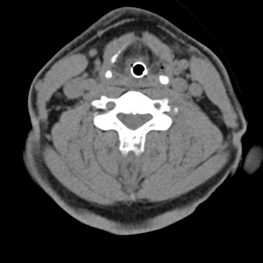 Cerebral hemorrhagic contusions and cervical spine fractures (Radiopaedia 32865-33841 F 32).jpg