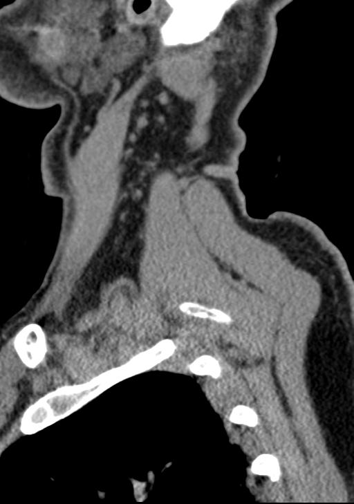 Cerebral hemorrhagic contusions and cervical spine fractures (Radiopaedia 32865-33841 G 16).jpg