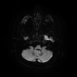 Cerebral metastases - melanoma (Radiopaedia 80972-94522 Axial DWI 40).jpg