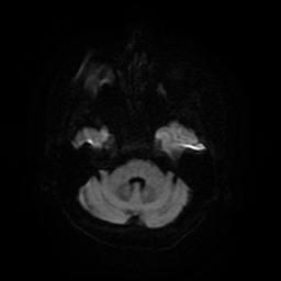 File:Cerebral metastases - melanoma (Radiopaedia 80972-94522 Axial DWI 41).jpg