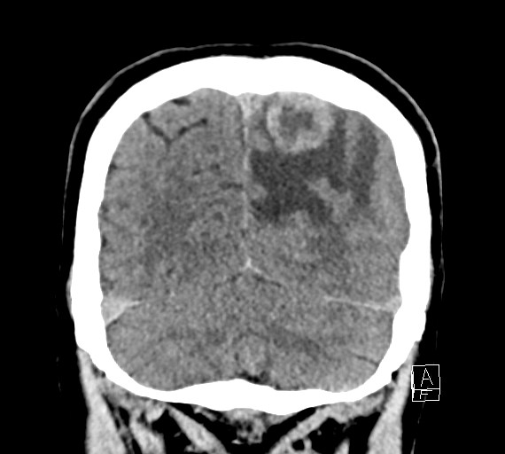 Cerebral metastases - testicular choriocarcinoma (Radiopaedia 84486-99855 Coronal C+ delayed 51).jpg