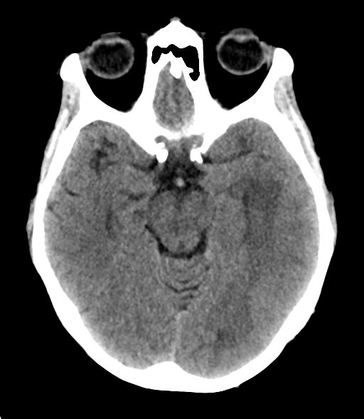 File:Cerebral metastasis (Radiopaedia 46744-51247 Axial non-contrast 12).png