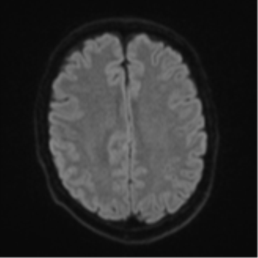 Cerebral metastasis - colorectal adenocarcinoma (Radiopaedia 50394-55765 Axial DWI 46).png