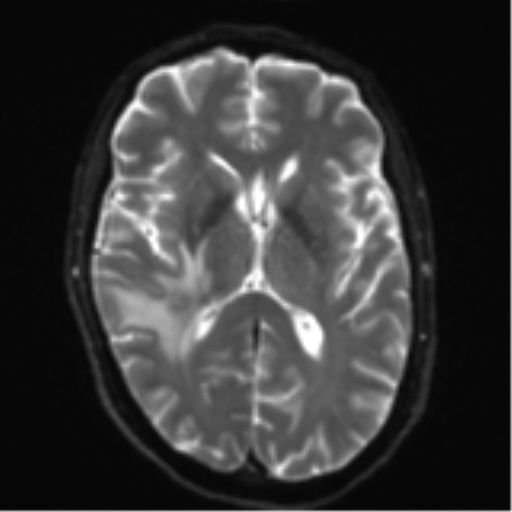 File:Cerebral metastasis - melanoma (Radiopaedia 54718-60954 Axial DWI 16).png