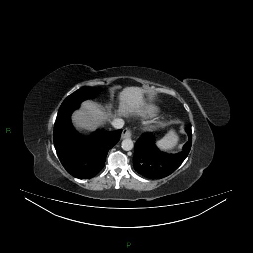 Cerebral metastasis from renal cell carcinoma (Radiopaedia 82306-96378 A 19).jpg