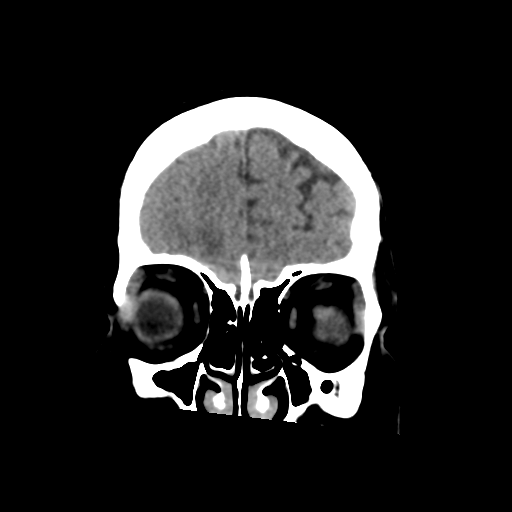Cerebral metastasis to basal ganglia (Radiopaedia 81568-95412 Coronal non-contrast 16).png