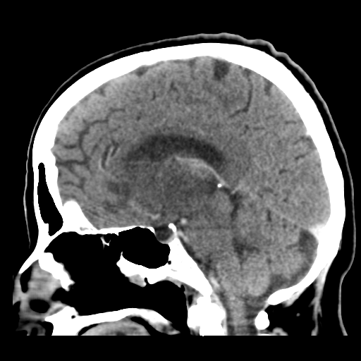 Cerebral metastasis to basal ganglia (Radiopaedia 81568-95412 Sagittal C+ delayed 31).png