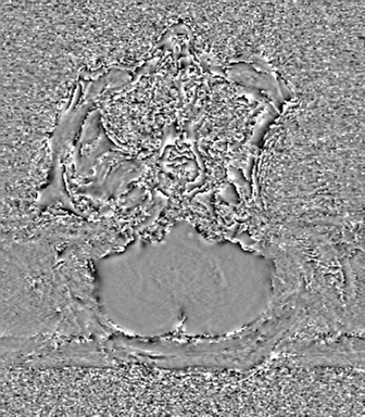 Cerebral metastasis to basal ganglia (Radiopaedia 81568-95413 Axial SWI phase 11).png
